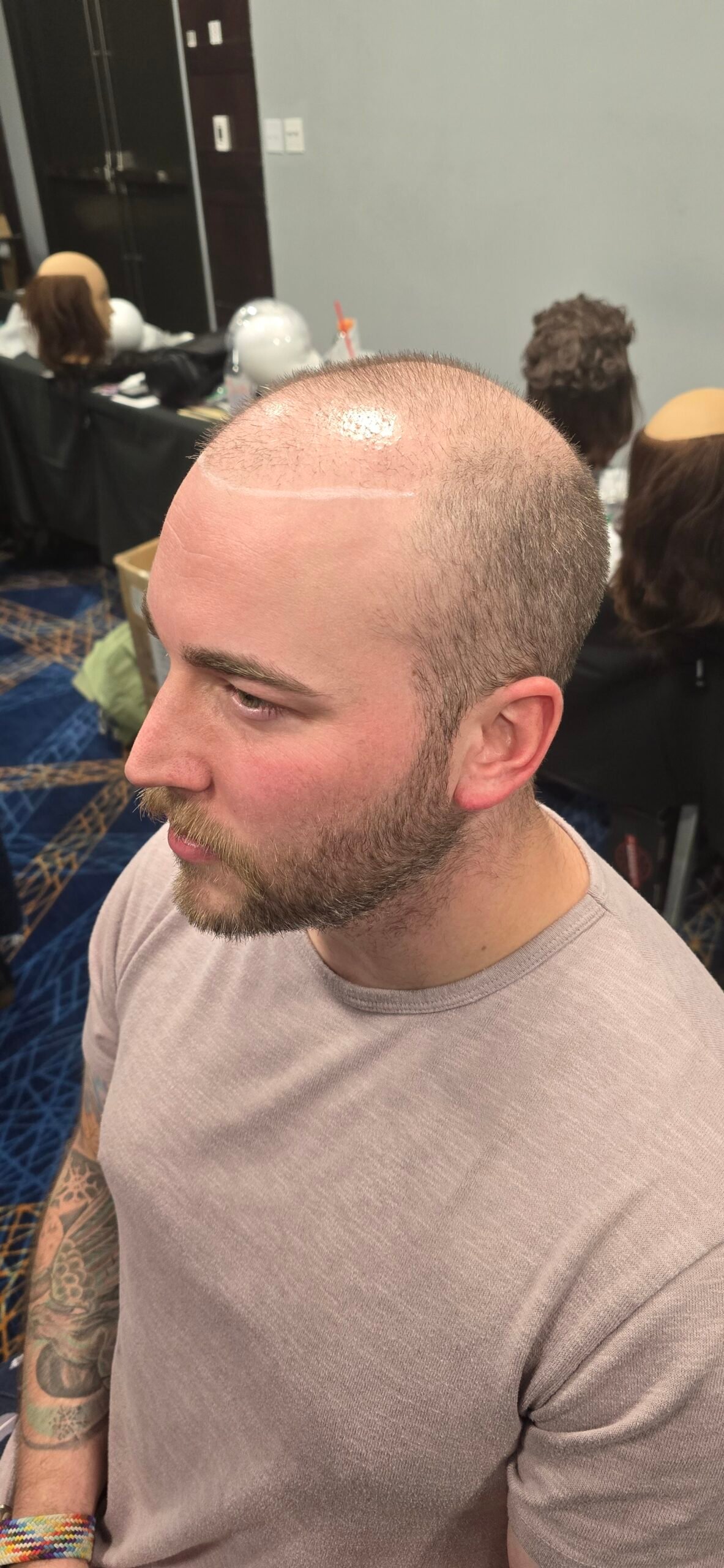 Before hair replacement