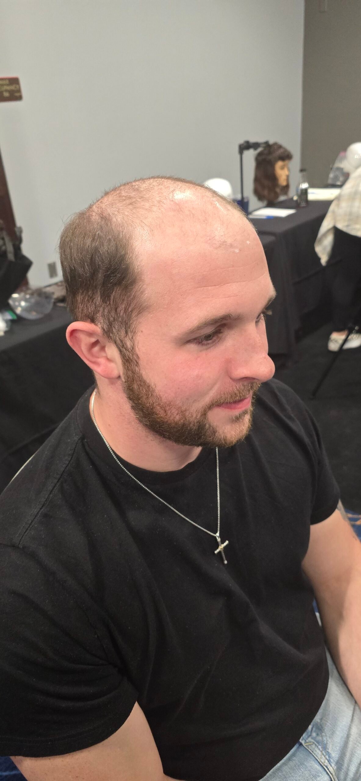 Before hair replacement