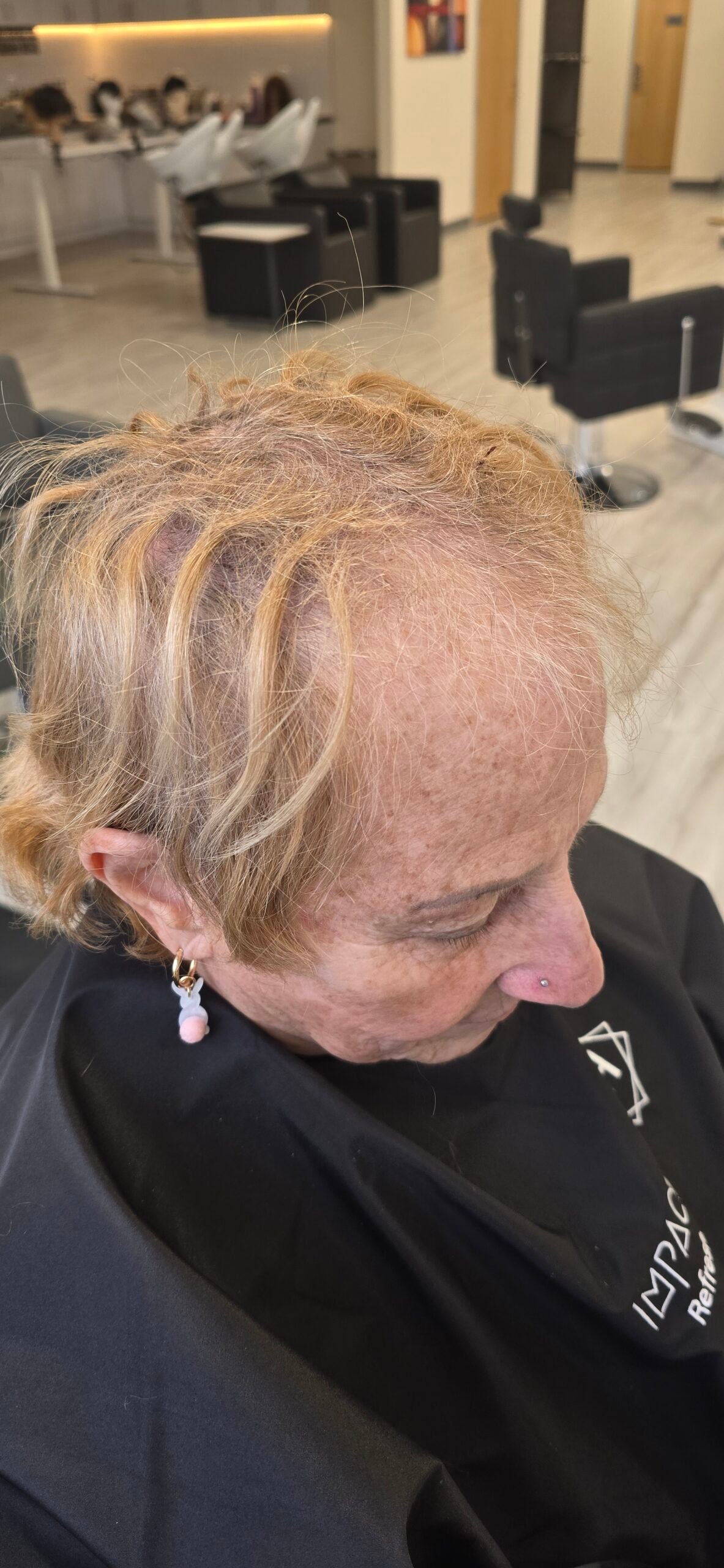 Before hair restoration